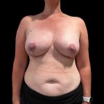 Vertical Lift + Implants Before & After Patient #6610