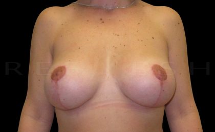 Vertical Lift + Implants Before & After Patient #6623