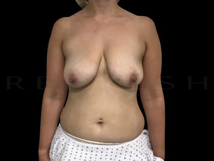 Vertical Lift + Implants Before & After Patient #6621