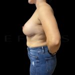 Vertical Lift + Implants Before & After Patient #6620