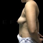 Vertical Lift + Implants Before & After Patient #6620