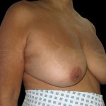 Breast Reconstruction Before & After Patient #6629