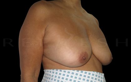 Breast Reconstruction Before & After Patient #6629
