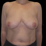 Breast Reconstruction Before & After Patient #6627