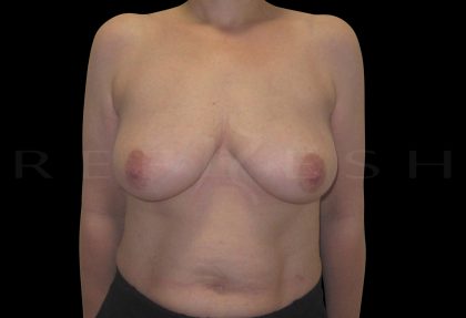Breast Reconstruction Before & After Patient #6627