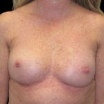 Breast Reconstruction Before & After Patient #6626