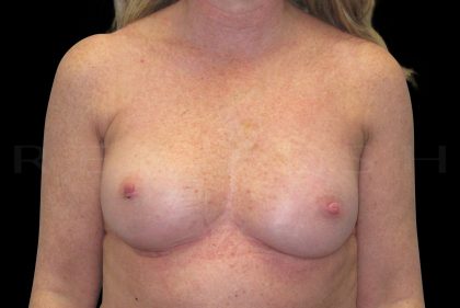 Breast Reconstruction Before & After Patient #6626