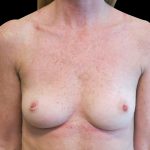 Breast Reconstruction Before & After Patient #6626