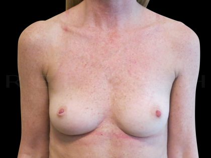 Breast Reconstruction Before & After Patient #6626