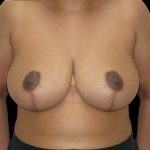 Breast Reduction Before & After Patient #6644