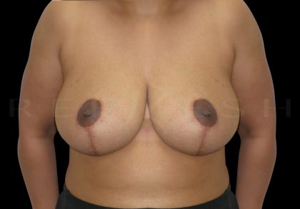 Breast Reduction Before & After Patient #6644