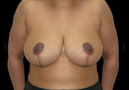 Breast Reduction Before & After Patient #6644