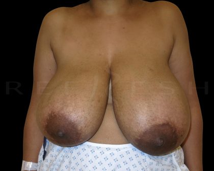 Breast Reduction Before & After Patient #6644