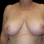 Breast Reduction Before & After Patient #6635