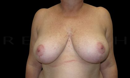 Breast Reduction Before & After Patient #6635