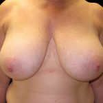 Breast Reduction Before & After Patient #6635