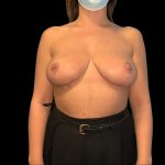 Breast Reduction Before & After Patient #6634