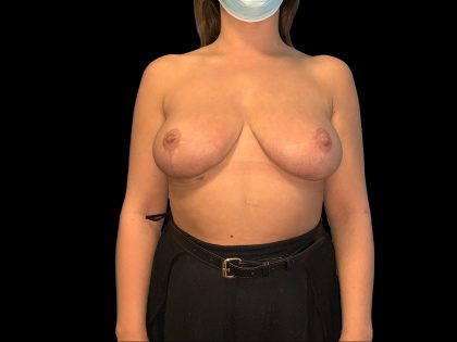 Breast Reduction Before & After Patient #6634