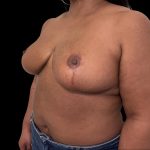 Breast Reduction Before & After Patient #6633