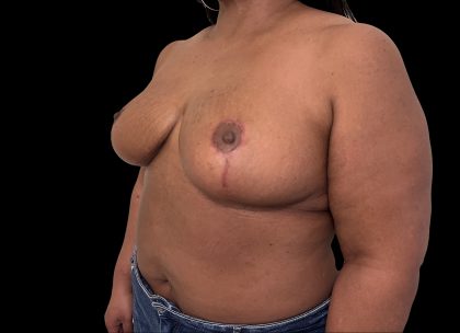 Breast Reduction Before & After Patient #6633