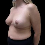 Breast Reduction Before & After Patient #6631