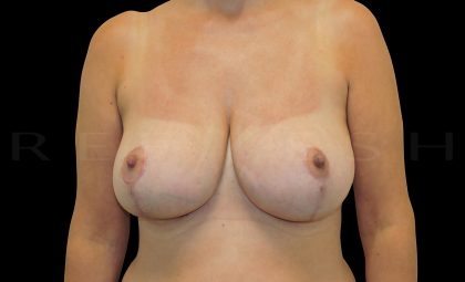 Breast Reduction Before & After Patient #6643