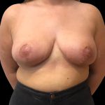 Breast Reduction Before & After Patient #6641