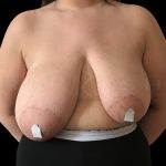 Breast Reduction Before & After Patient #6641