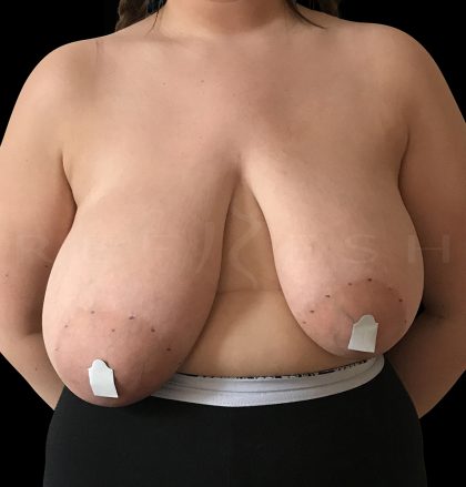 Breast Reduction Before & After Patient #6641