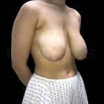 Breast Reduction Before & After Patient #6640