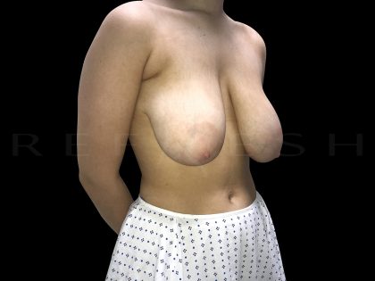 Breast Reduction Before & After Patient #6640