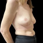 Breast Reduction Before & After Patient #6639