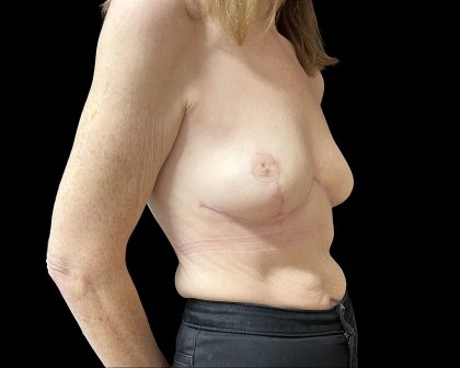 Breast Reduction Before & After Patient #6639