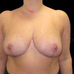Breast Reduction Before & After Patient #6637