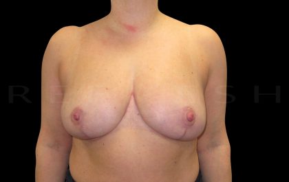 Breast Reduction Before & After Patient #6637