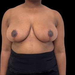 Breast Reduction Before & After Patient #6636