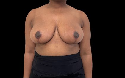 Breast Reduction Before & After Patient #6636