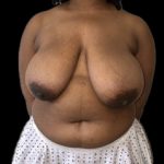 Breast Reduction Before & After Patient #6636