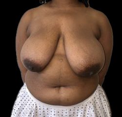Breast Reduction Before & After Patient #6636