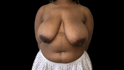 Breast Reduction Before & After Patient #6636