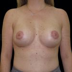 Donut Lift + Implants Before & After Patient #6608