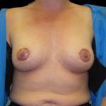 Donut Lift + Implants Before & After Patient #6605