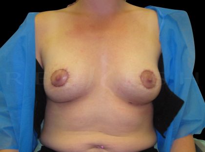 Donut Lift + Implants Before & After Patient #6605