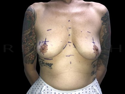 Donut Lift + Implants Before & After Patient #6603
