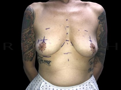 Breast Lift - Harley Clinic