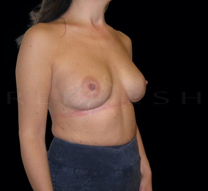 Breast Implant Exchange + Enbloc Capsulectomy Before & After Patient #6548