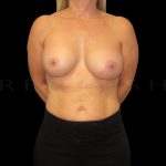 Breast Implant Exchange + Enbloc Capsulectomy Before & After Patient #6549