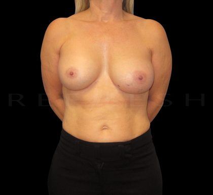 Breast Implant Exchange + Enbloc Capsulectomy Before & After Patient #6549