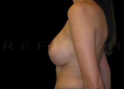 Breast Implant Exchange + Enbloc Capsulectomy + Breast Lift Before & After Patient #6560