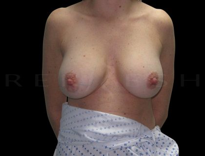 Breast Implant Exchange + Enbloc Capsulectomy + Breast Lift Before & After Patient #6559